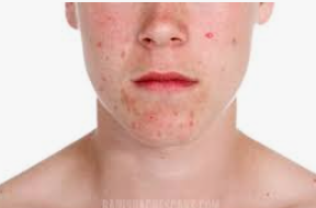 Say goodbye to "acne vulgaris"